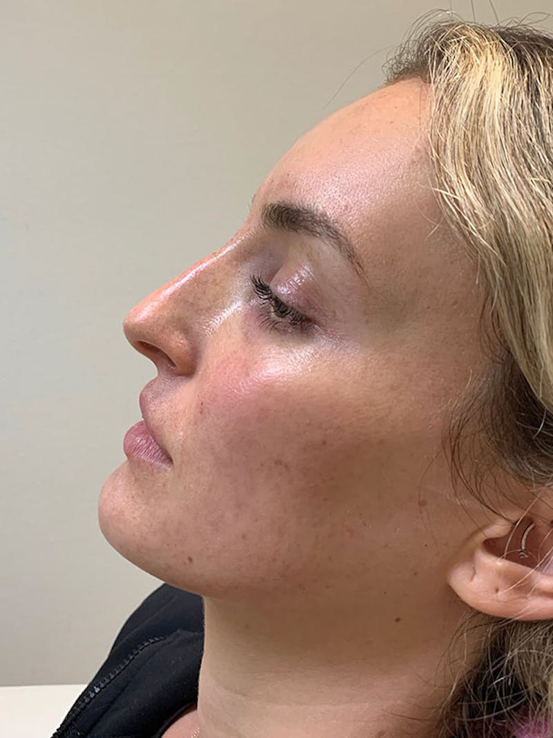 Non-Surgical Rhinoplasty Before & After Gallery - Patient 51538765 - Image 2
