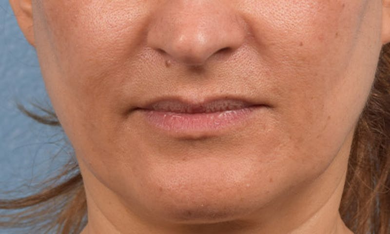 Ultherapy Before & After Gallery - Patient 51538768 - Image 1