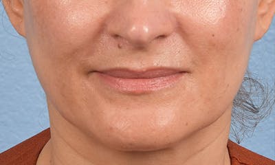 Ultherapy Before & After Gallery - Patient 51538768 - Image 2