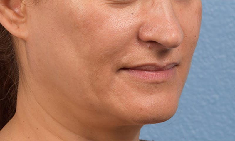 Ultherapy Before & After Gallery - Patient 51538768 - Image 3