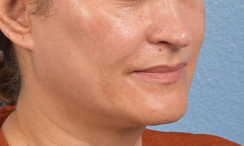 Ultherapy Before & After Gallery - Patient 51538768 - Image 4