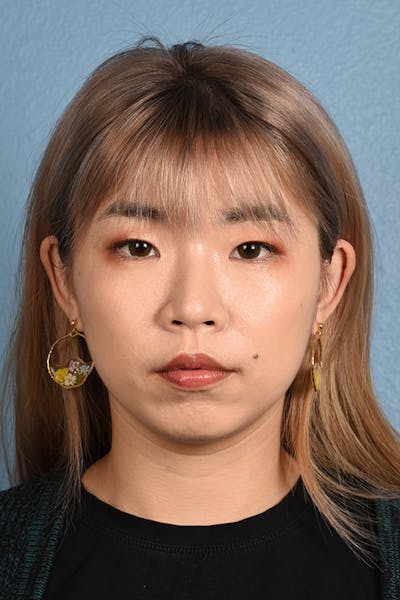 Ultherapy Before & After Gallery - Patient 51538771 - Image 2