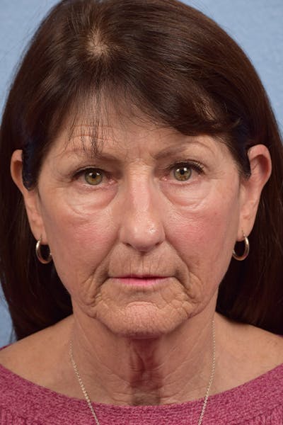 Chemical Peel Before & After Gallery - Patient 51538770 - Image 1