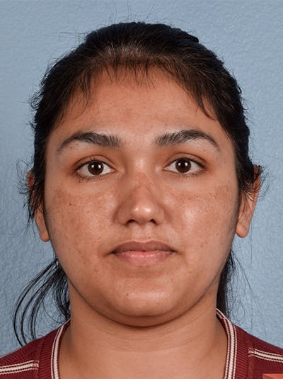 Skincare Before & After Gallery - Patient 51538777 - Image 1