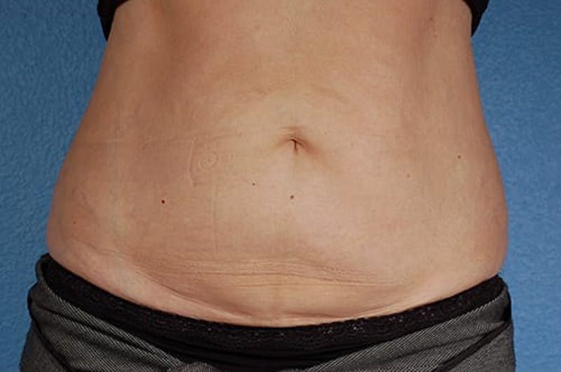 Coolsculpting Before & After Gallery - Patient 51538782 - Image 2