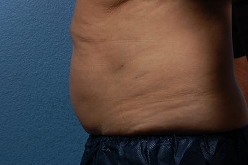 Coolsculpting Before & After Gallery - Patient 51538782 - Image 3
