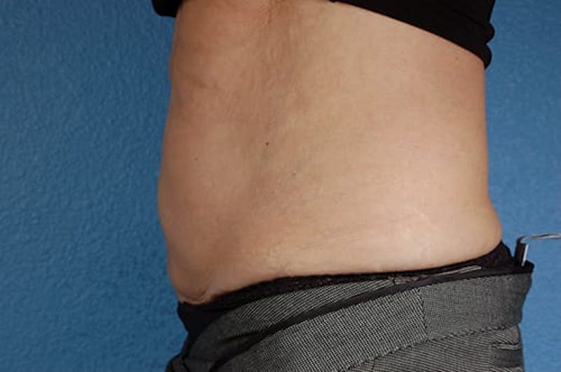 Coolsculpting Before & After Gallery - Patient 51538782 - Image 4