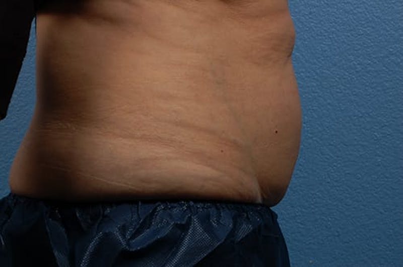 Coolsculpting Before & After Gallery - Patient 51538782 - Image 5