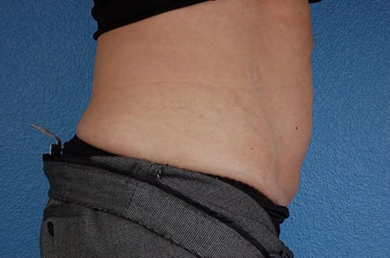 Coolsculpting Before & After Gallery - Patient 51538782 - Image 6