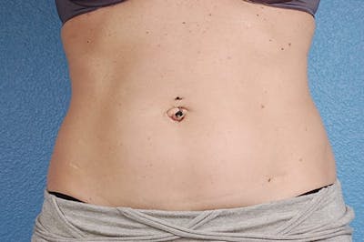 Coolsculpting Before & After Gallery - Patient 51538789 - Image 1