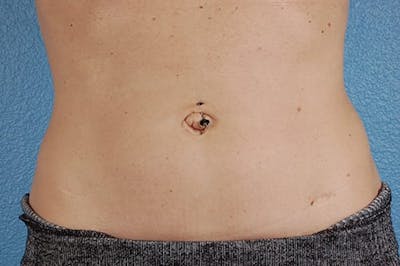 Coolsculpting Before & After Gallery - Patient 51538789 - Image 2