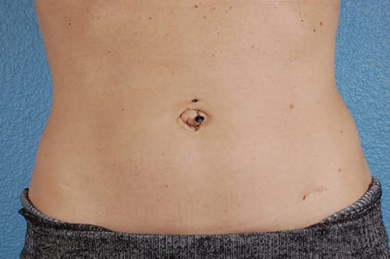 Coolsculpting Before & After Gallery - Patient 51538789 - Image 2