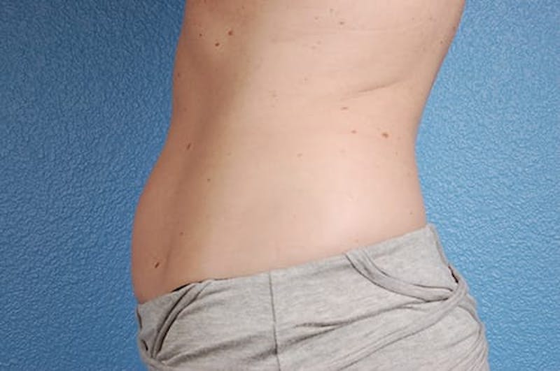 Coolsculpting Before & After Gallery - Patient 51538789 - Image 3