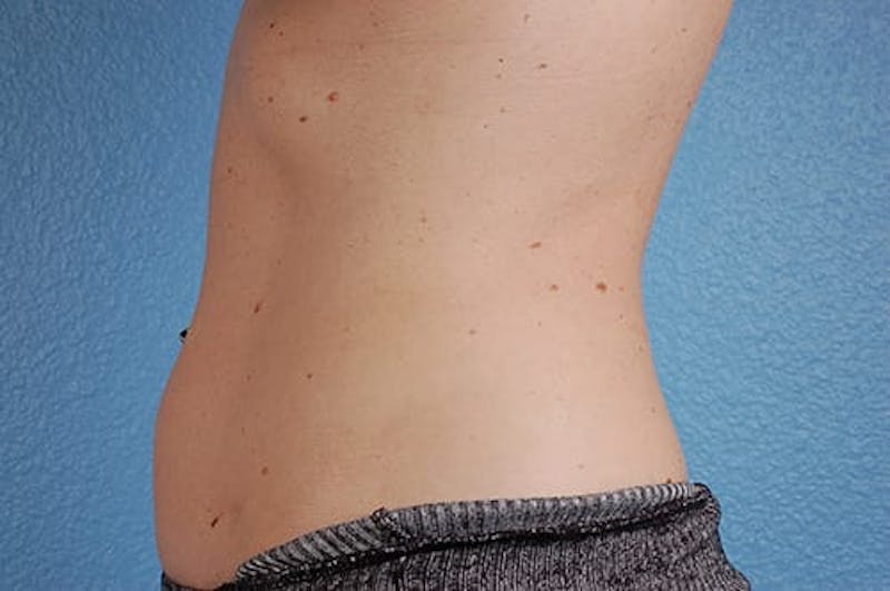 Coolsculpting Before & After Gallery - Patient 51538789 - Image 4