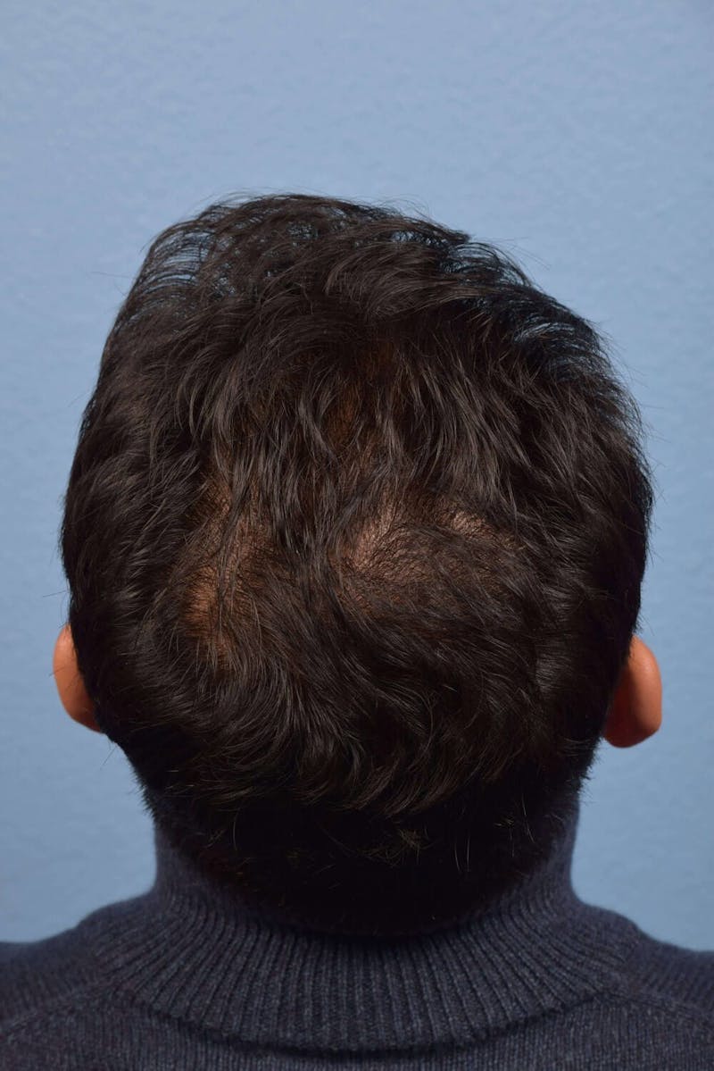 Hair Rejuvenation with PRP Before & After Gallery - Patient 51538788 - Image 1