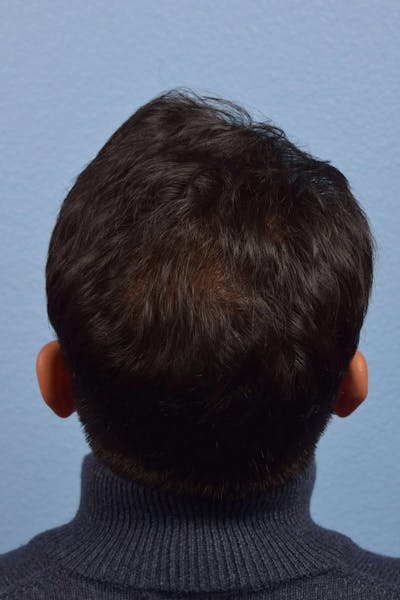 Hair Rejuvenation with PRP Before & After Gallery - Patient 51538788 - Image 2
