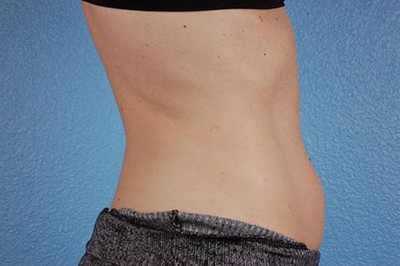 Coolsculpting Before & After Gallery - Patient 51538789 - Image 6