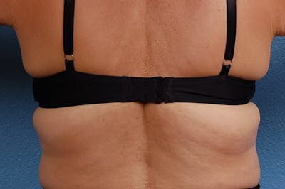 Coolsculpting Before & After Gallery - Patient 51538790 - Image 2