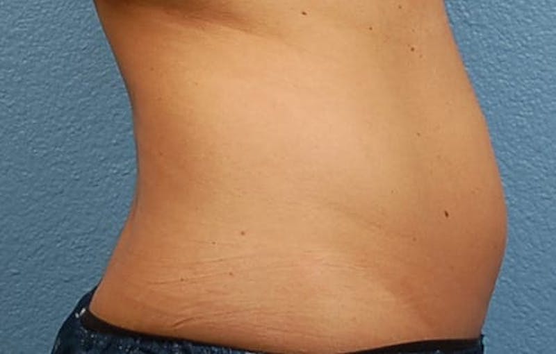 Coolsculpting Before & After Gallery - Patient 51538792 - Image 5
