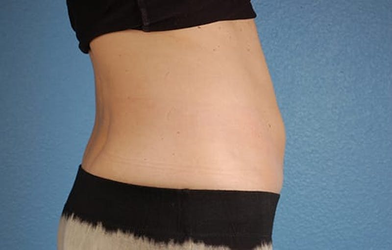 Coolsculpting Before & After Gallery - Patient 51538792 - Image 6