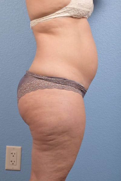Coolsculpting Before & After Gallery - Patient 51538794 - Image 1