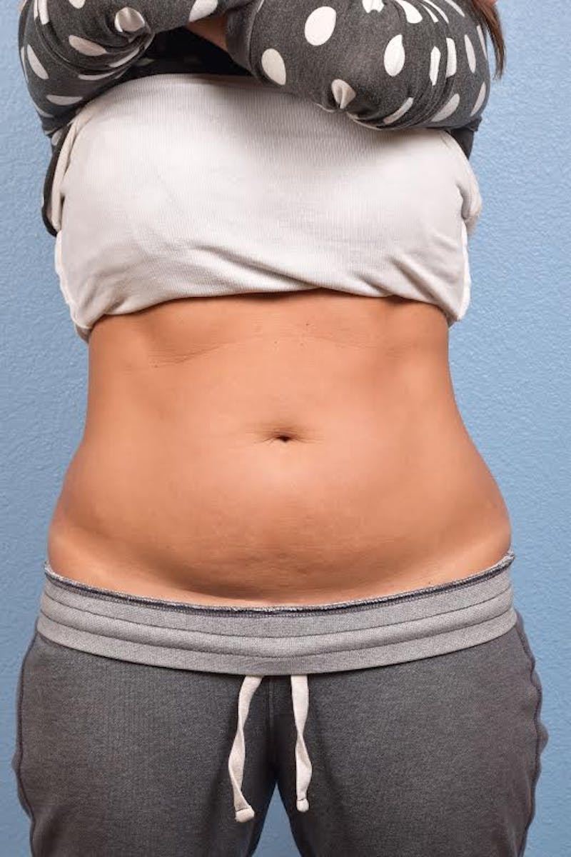 Coolsculpting Before & After Gallery - Patient 51538795 - Image 3