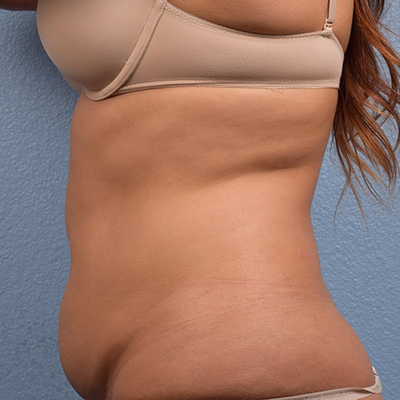 Coolsculpting Before & After Gallery - Patient 51538796 - Image 3