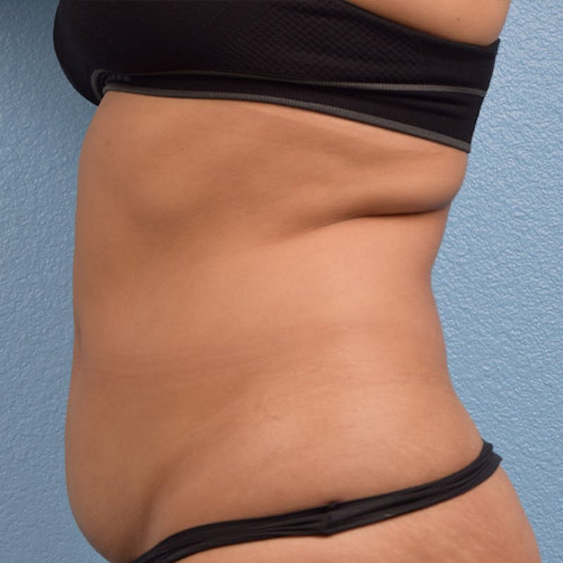 Coolsculpting Before & After Gallery - Patient 51538796 - Image 4