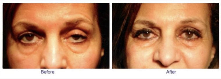 Droopy Eyelid Lift (