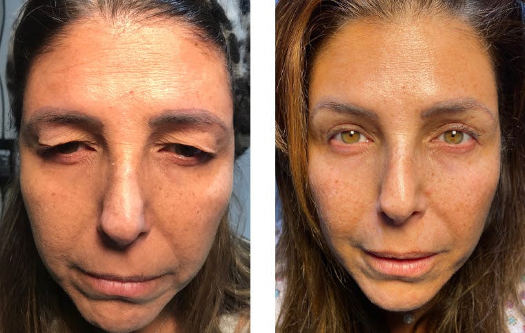 Blepharoplasty (Eyelid Surgery) Before & After Gallery - Patient 55495836 - Image 1
