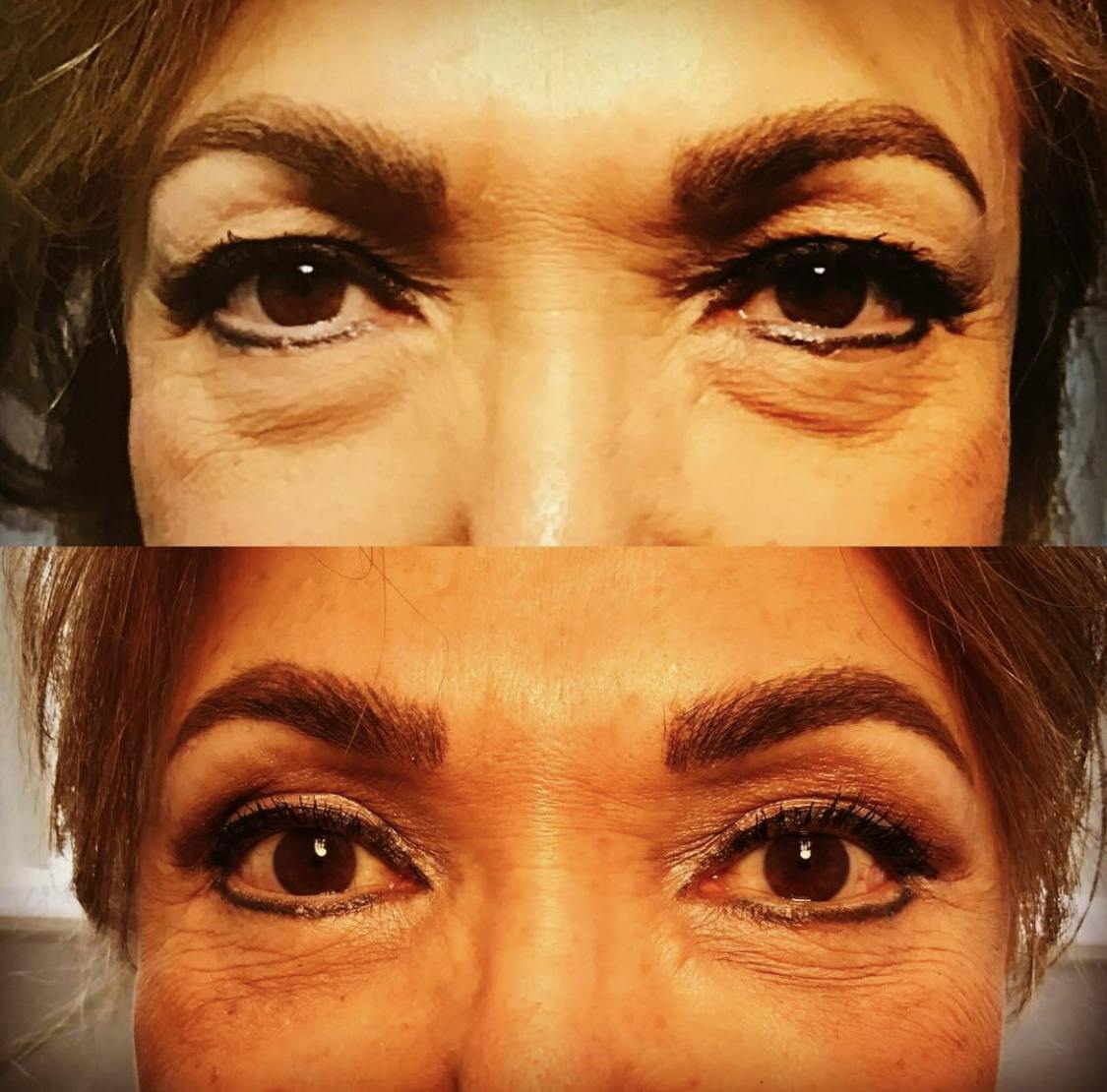 Blepharoplasty (Eyelid Surgery) Before & After Gallery - Patient 55495870 - Image 1