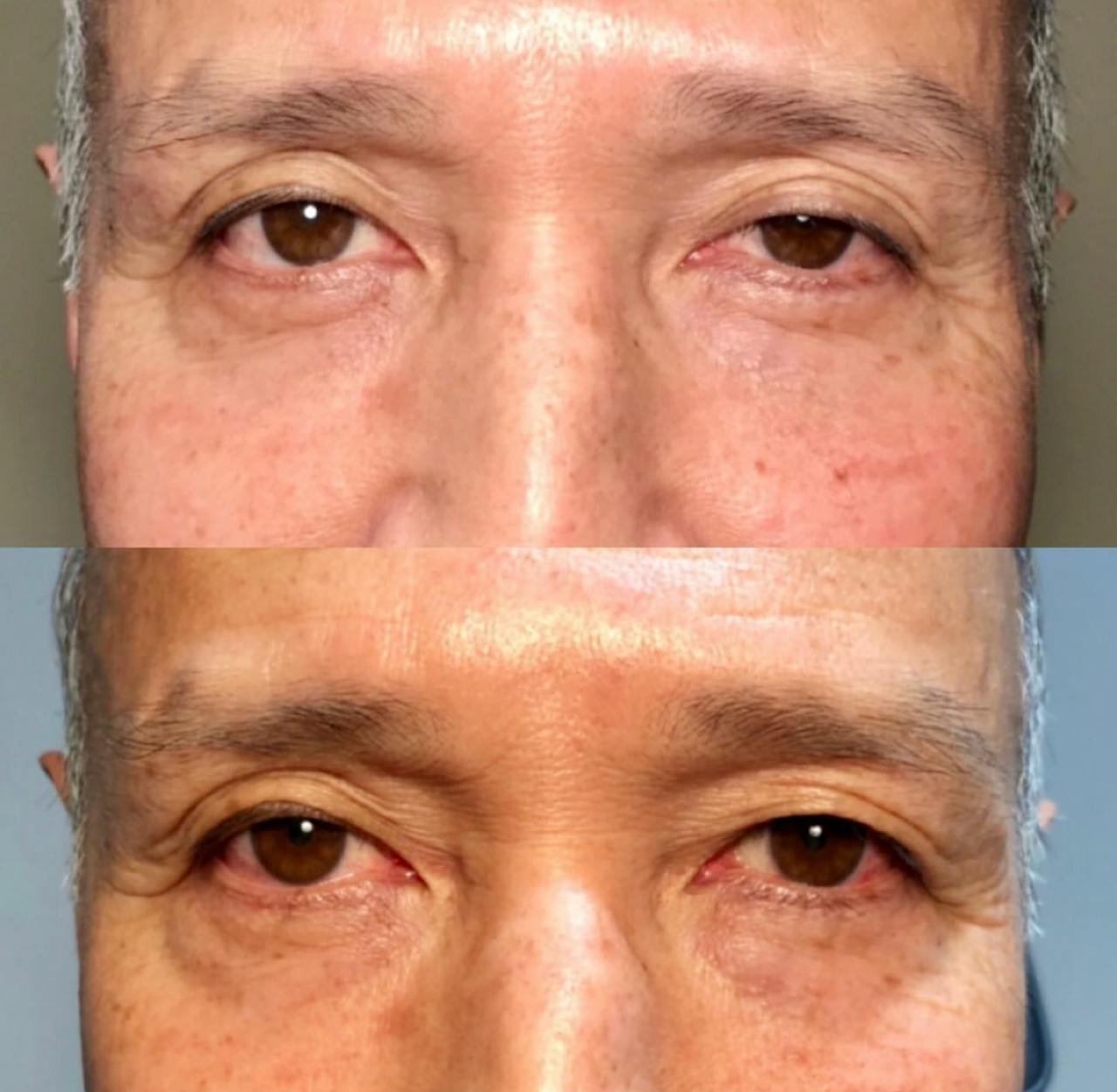 Droopy Eyelid Lift (