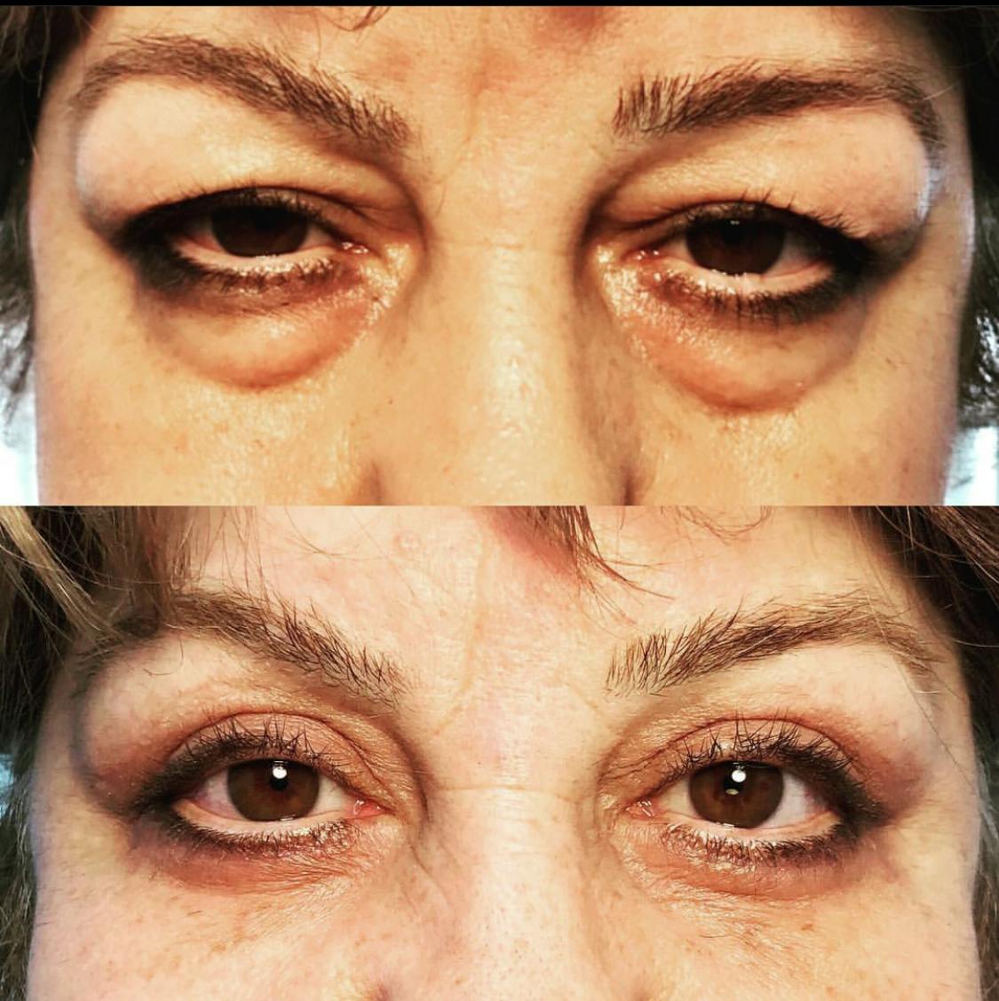 Blepharoplasty (Eyelid Surgery) Before & After Gallery - Patient 55495871 - Image 1