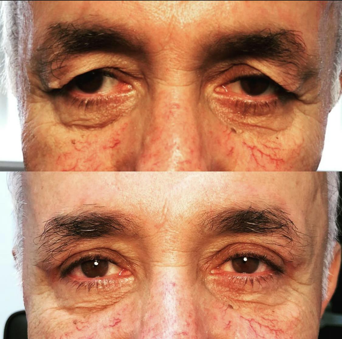 Blepharoplasty (Eyelid Surgery) Before & After Gallery - Patient 55495837 - Image 1