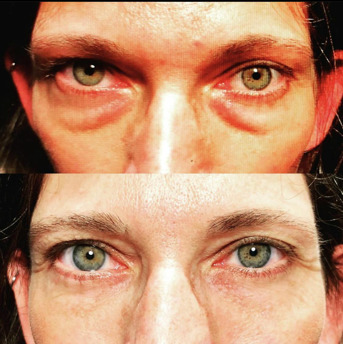 Blepharoplasty (Eyelid Surgery) Before & After Gallery - Patient 55495858 - Image 1