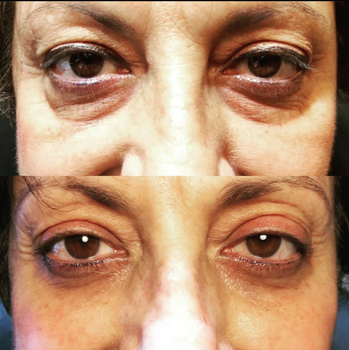Blepharoplasty (Eyelid Surgery) Gallery - Patient 55495872 - Image 1