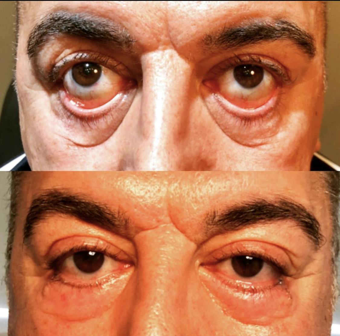 Ectropion (Everted Eyelid) Correction Before & After Gallery - Patient 53704358 - Image 1