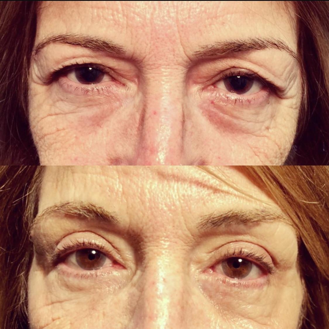Blepharoplasty (Eyelid Surgery) Before & After Gallery - Patient 55495873 - Image 1