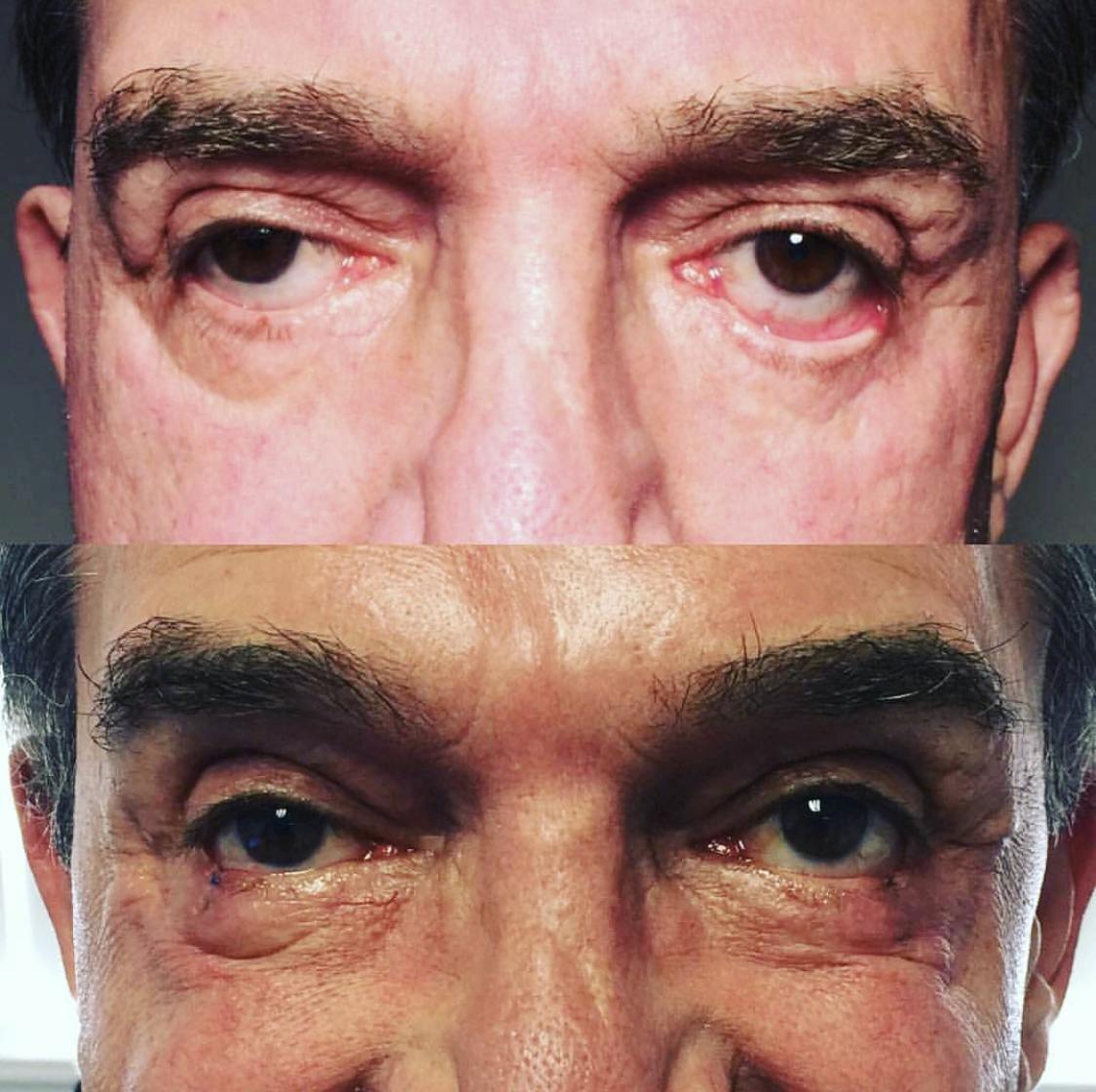 Ectropion (Everted Eyelid) Correction Before & After Gallery - Patient 53704370 - Image 1
