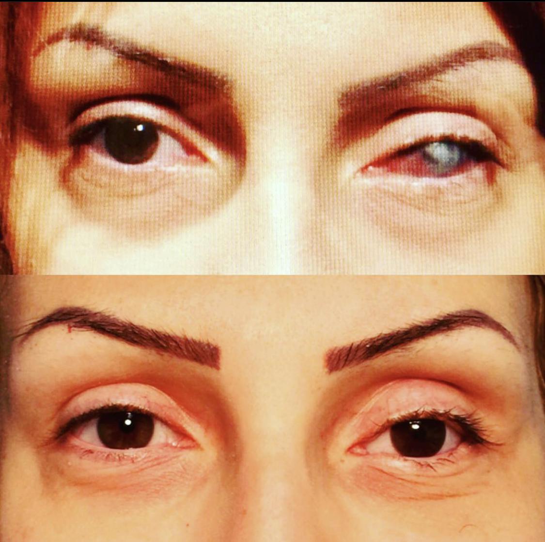Droopy Eyelid Lift (