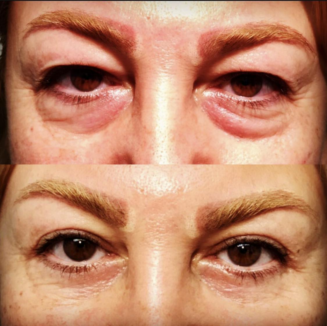 Blepharoplasty (Eyelid Surgery) Before & After Gallery - Patient 55495874 - Image 1