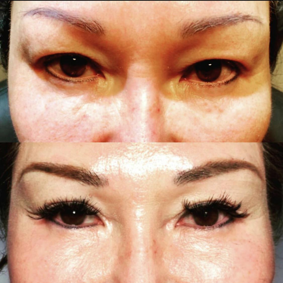 Blepharoplasty (Eyelid Surgery) Before & After Gallery - Patient 55495838 - Image 1
