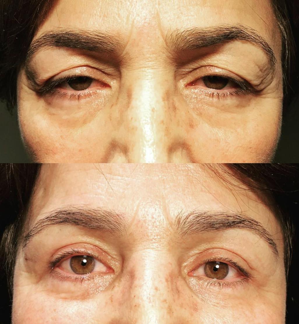 Blepharoplasty (Eyelid Surgery) Before & After Gallery - Patient 55495875 - Image 1