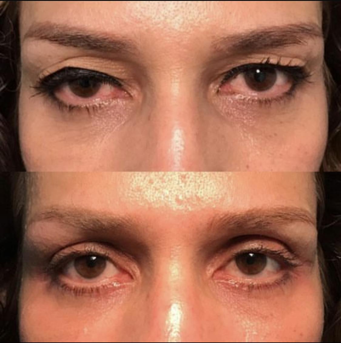Droopy Eyelid Lift (