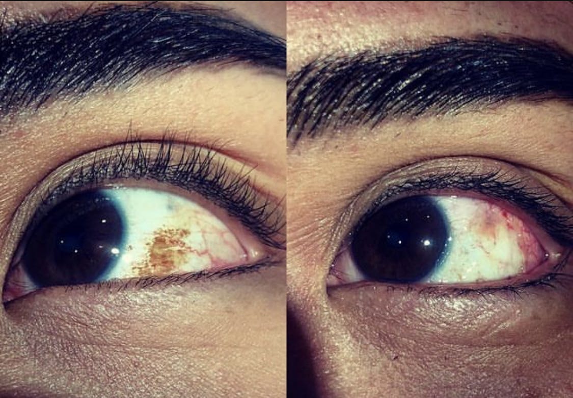 Eye 