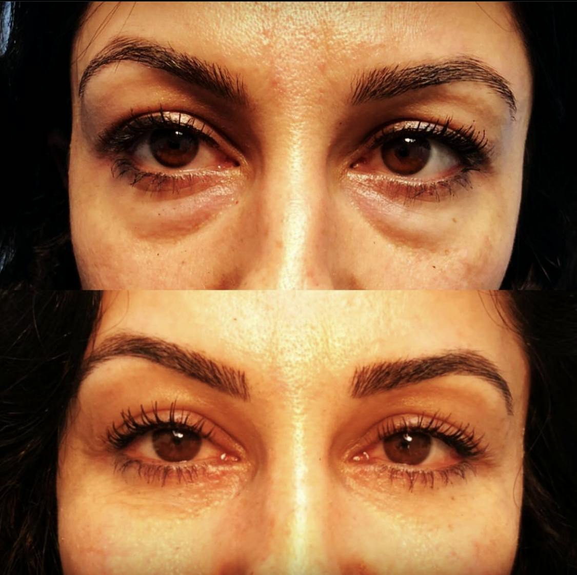 Blepharoplasty (Eyelid Surgery) Before & After Gallery - Patient 55495859 - Image 1