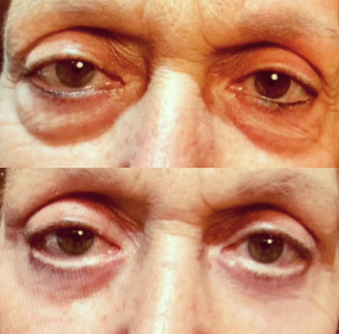 Blepharoplasty (Eyelid Surgery) Gallery - Patient 55495860 - Image 1