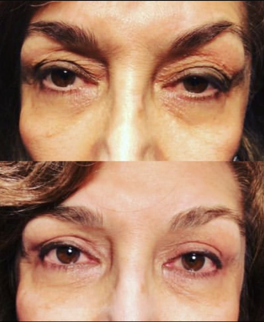 Blepharoplasty (Eyelid Surgery) Before & After Gallery - Patient 55495853 - Image 1