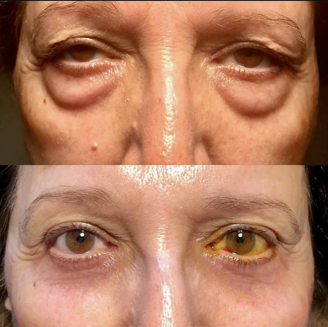 Blepharoplasty (Eyelid Surgery) Before & After Gallery - Patient 55495883 - Image 1