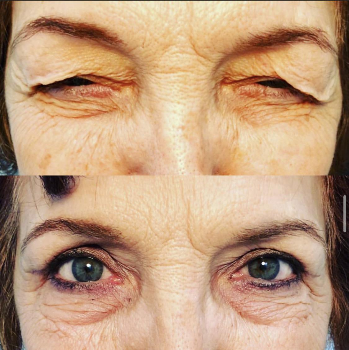 Droopy Eyelid Lift (